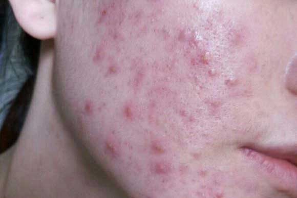 脸上红疹痤疮很严重,红疹性痤疮怎么治?