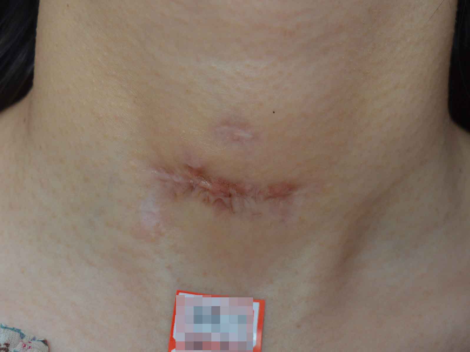 疤痕能完全修复吗,什么能消除疤痕?