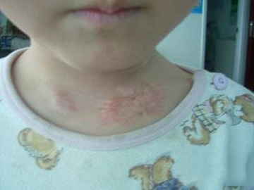儿童消除疤痕的方式,小孩涂什么去疤痕最好?