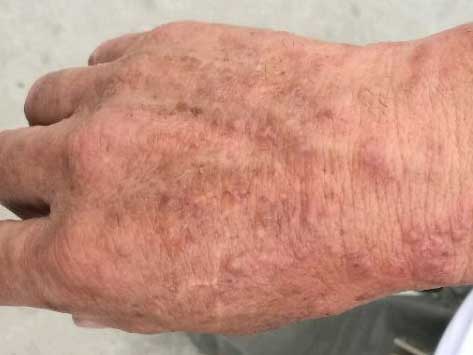 老年皮肤瘙痒的病因,老年皮肤瘙痒治疗的方法